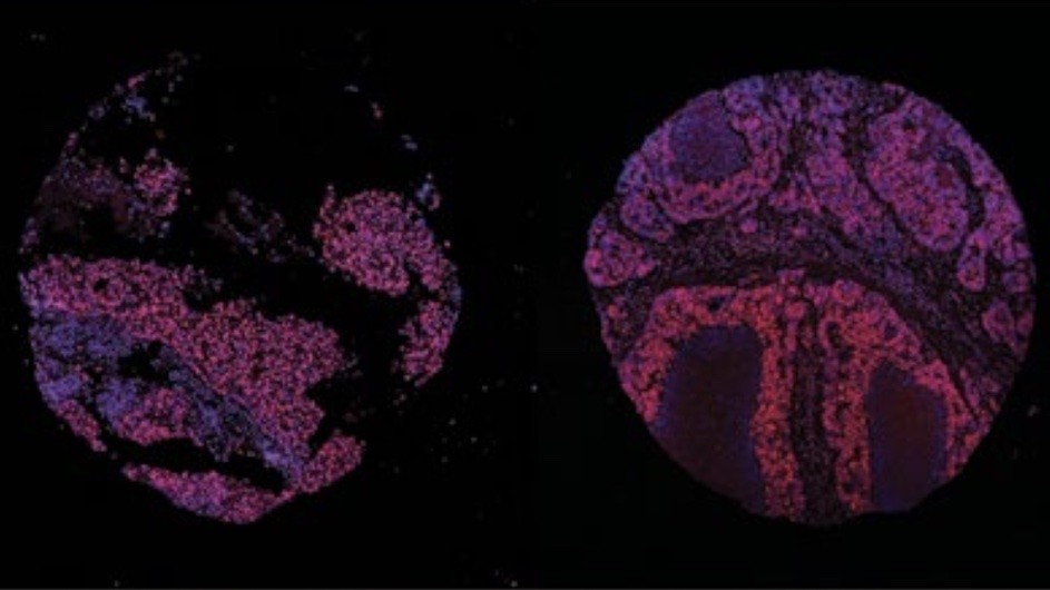 Sections of two metastases from people showing expression of the Malat1 gene.