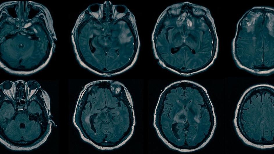 MRI images of brains.