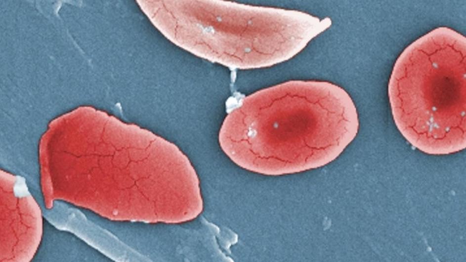 Normal red blood cells and a sickle cell red blood cell (top, center) from a patient with sickle cell anemia