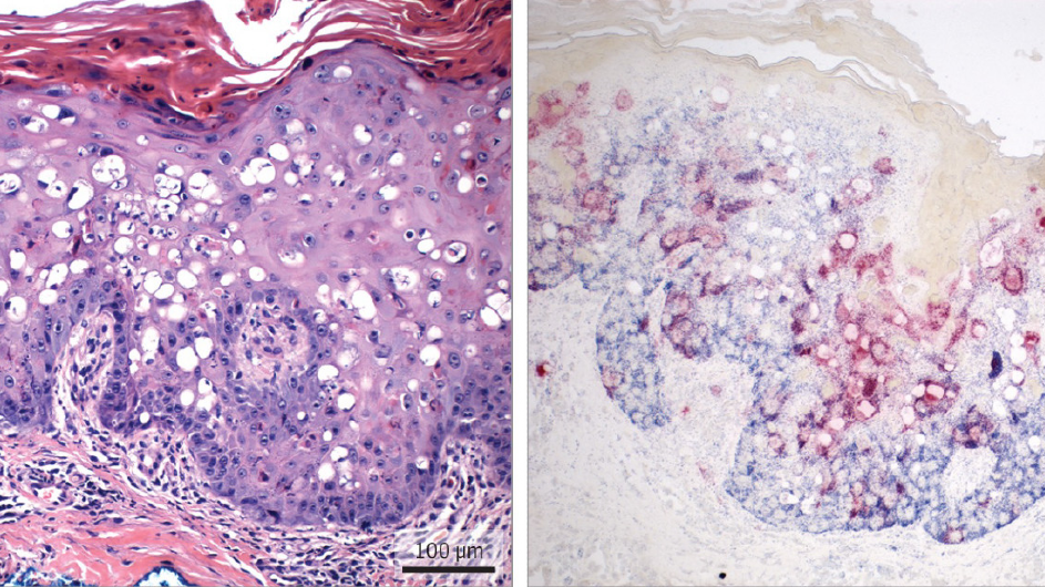 Microscopic images of skin biopsies taken from patients infected with human polyomavirus.