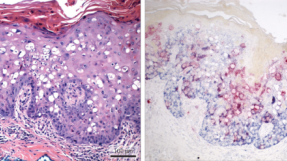 Microscopic images of skin biopsies taken from patients infected with human polyomavirus. Microscopic images of skin biopsies taken from patients infected with human polyomavirus.