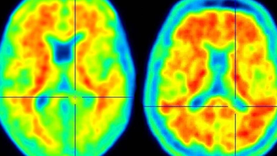 Side by side images of two brain scans.