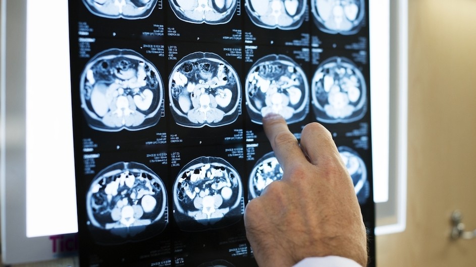 Researchers have found that individuals with anorexia nervosa use different brain systems when deciding what to eat. A doctor points at images of patient brain scans.