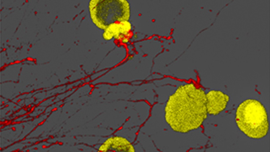 When sensory neurons (red) are cultured with stomach cancer organoids (yellow), the neuron and cancer cells create connections that resemble synapses and establish an electrical circuit among the cells. Images provided by Timothy Wang / Columbia University Vagelos College of Physicians and Surgeons.