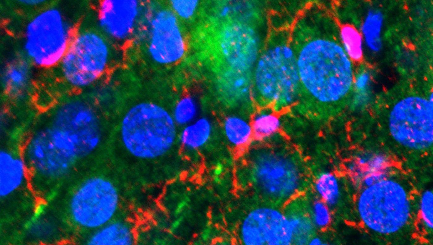 The hippocampus of a female mouse that has been genetically engineered to overproduce TIA1 protein. The hippocampus of a female mouse that has been genetically engineered to overproduce TIA1 protein.