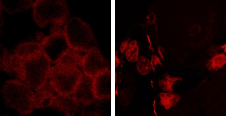 Mutated beta-catenin in bone cells may cause up to 40 percent of acute myeloid leukemia cases. In the cells of healthy subjects (left), beta catenin proteins (red dots) sit along the outer edges of the cell. In approximately 40 percent of AML patients (right), abnormal beta-catenin proteins (red dots) move into the cell interior; in mouse models, this movement sets cancer-causing changes into motion. Credit: Dr. Aruna Kode/Kousteni lab, Columbia University Medical Center. Red blood cells on black background