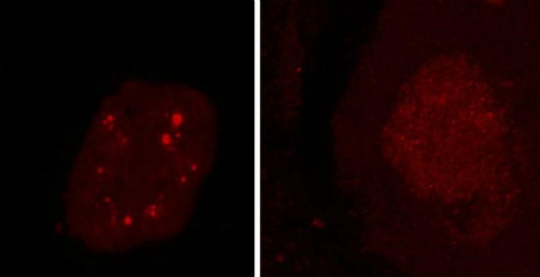 Researchers found clumps of non-functioning hnRNP H and at least three other RNA-binding proteins in the brain cells of people who had died with ALS, frontotemporal dementia or both. Bright red clumps of hnRNP H can be seen in the spinal cord motor neurons at left. Healthy neurons are shown at right. (Images: Aarti Sharma /Columbia University) Side-by-side scans show two images of a brain, one with red clumps of proteins and one without
