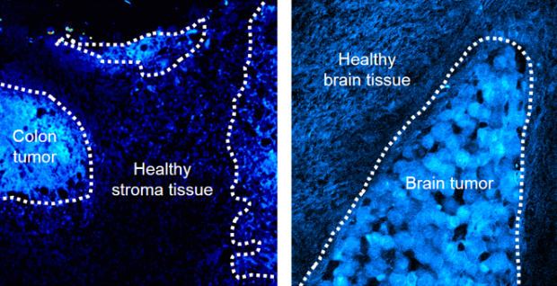 Using deuterium-labeled SRS imaging, researchers watched a bright line form around the above colon and brain tumors in mice. As the cancerous cells divided at a faster pace than the healthy cells, more deuterium was incorporated into their new proteins and lipids, suggesting that the method could be used to remove tumors more precisely. (Min lab/Columbia)