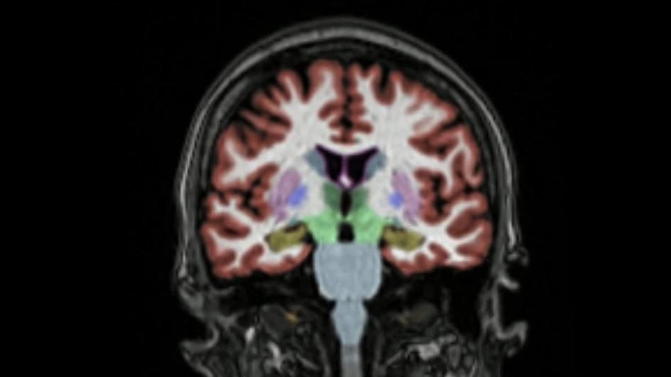 A view of the brain as seen with MRI imaging.