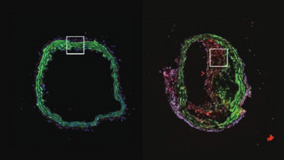 DNA damage, stained red, accumulates as atherosclerosis progresses in mouse arteries.