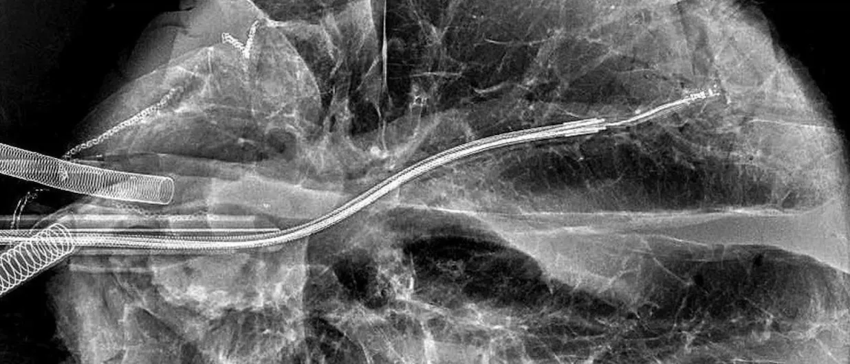 Gordana Vunjak-Novakovic's lab is developing nanoparticles to carry therapeutic cargo deep into the lungs and ultrathin catheters to enhance and better control delivery. 