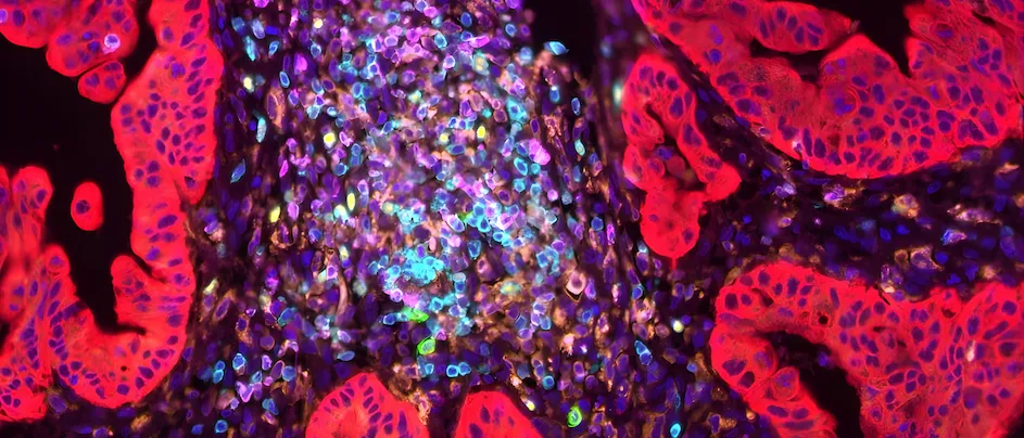 New research on pancreatic cancer cells could help anticipate and block their metastasis.