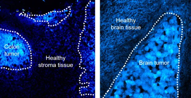 Using deuterium-labeled SRS imaging, researchers watched a bright line form around the above colon and brain tumors in mice. As the cancerous cells divided at a faster pace than the healthy cells, more deuterium was incorporated into their new proteins and lipids, suggesting that the method could be used to remove tumors more precisely. (Min lab/Columbia)