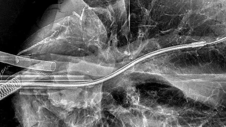 The Vunjak-Novakovic lab is developing nanoparticles to carry therapeutic cargo deep into the lungs and ultrathin catheters to enhance and better control delivery.