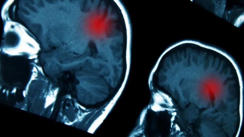 Brain scan images.