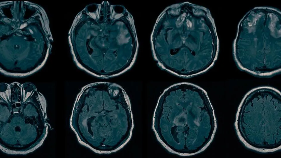 A collage of MRI scans of the brain.