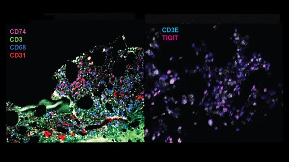 Fluorescence imaging of specific proteins using the CODEX technology in a responder patient (left) and a nonresponder patient (right). In responder sample pre-treatment (left) we see fluorescence from markers denoting different cell types. In contrast, in non responder sample post-treatment (right) we see high overlap of CD3E and TIGIT, suggestive of T cell exhaustion. Credit: Azizi lab/Columbia Engineering